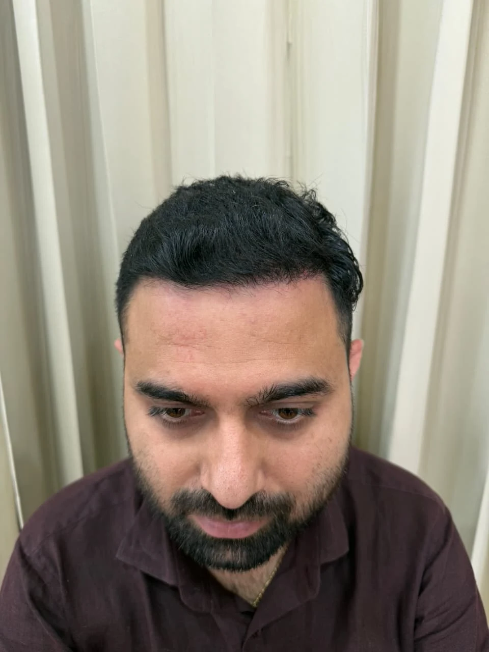 Hair transplant in Ahmedabad after treatment result - OZONE