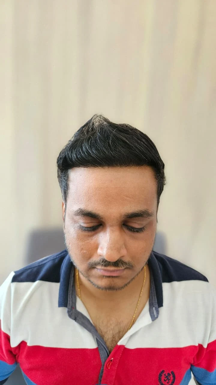 Hair restoration dense result after treatment - OZONE Ahmedabad