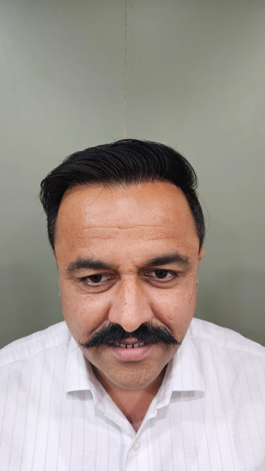 Natural dense hairline after hair transplant - OZONE