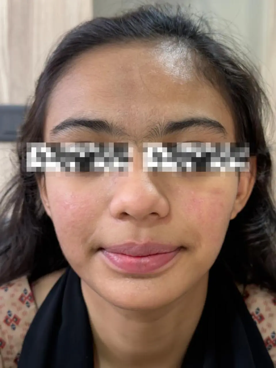 Clear smooth skin after acne treatment - OZONE Clinic Ahmedabad